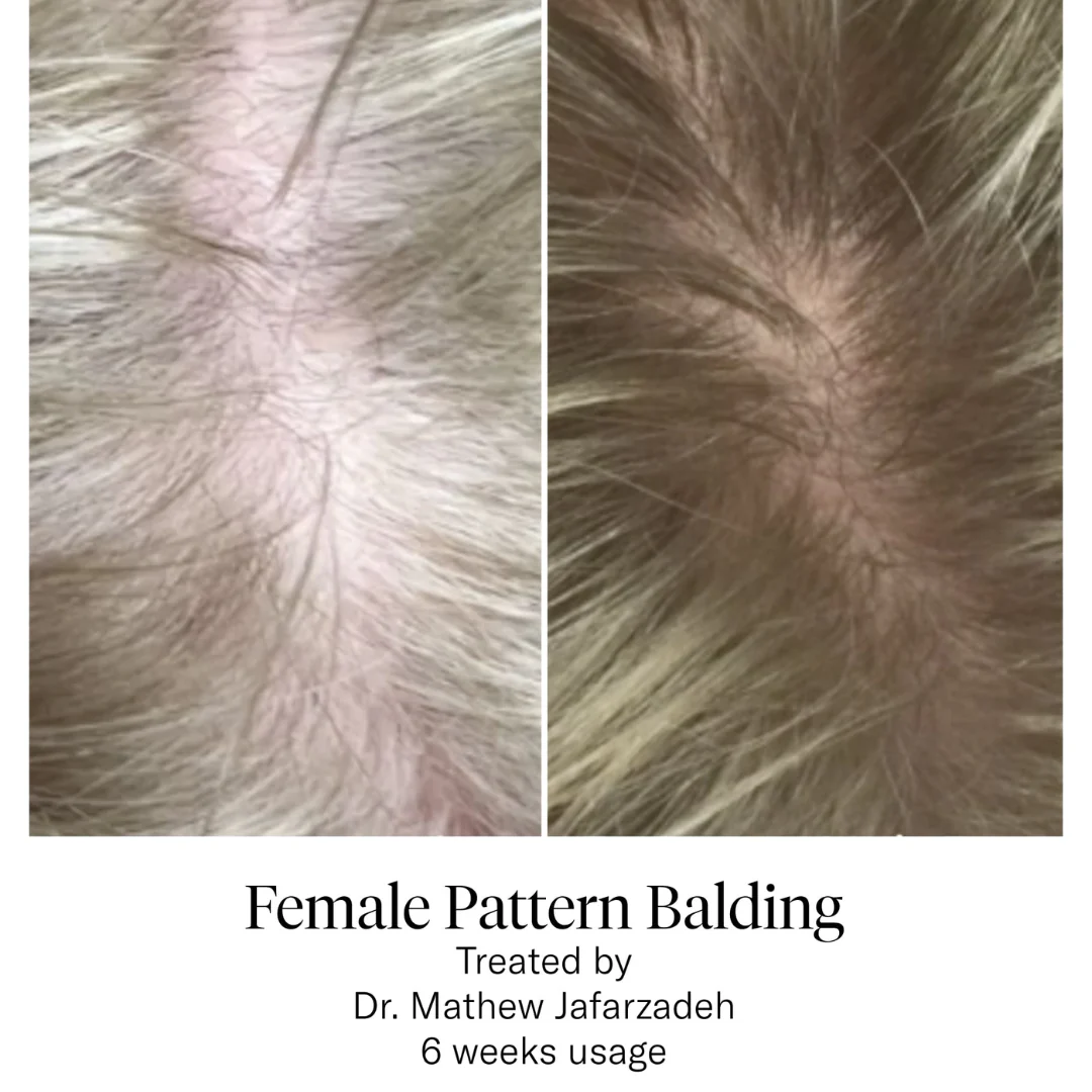 Calecim Advanced Hair System - Image 4
